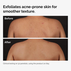 Salicylic Acid 0.5% Body Serum